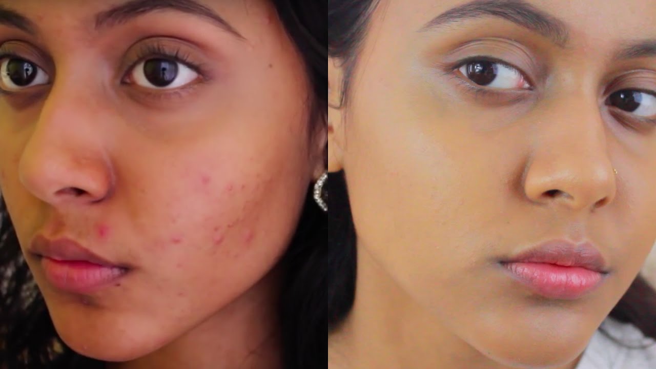 acne-scar-treatment-before-after